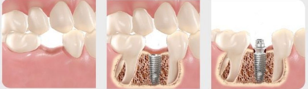 DrLeo-Implantes-010 Implantes Dentários em Lavras