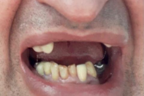 DrLeo-implantes-001 Implantes Dentários em Lavras