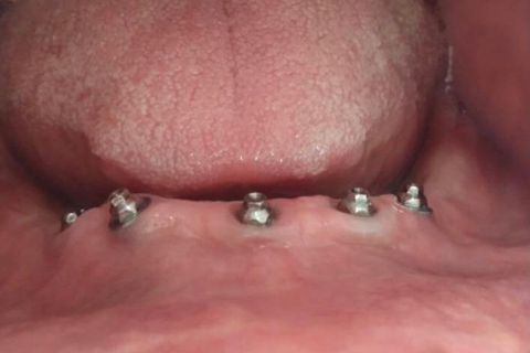 DrLeo-implantes-002 Implantes Dentários em Lavras