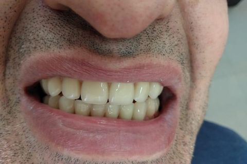 DrLeo-implantes-006 Implantes Dentários em Lavras