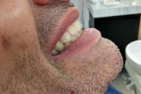DrLeo-implantes-007 Implantes Dentários em Lavras
