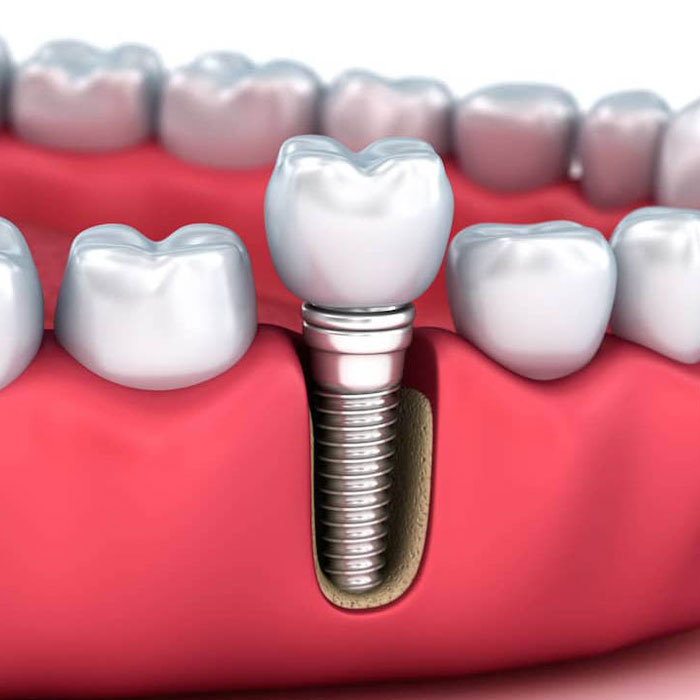 DrLeo-implantes-008 Implantes Dentários em Lavras